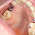 Sedation Options for Dental Implant Surgery: What You Need to Know