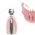 Understanding Mini Dental Implants