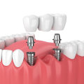 Financing Options for Those Without Insurance: Covering the Cost of Dental Implants