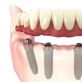 The Benefits of All-on-4 Implants