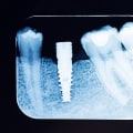 All You Need to Know About X-Rays and Imaging for Dental Implants