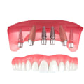 Instructions Before Surgery for Dental Implants