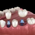 Understanding Abutments: Why They're Necessary for a Successful Dental Implant