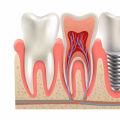 Understanding Endosteal Implants: A Complete Guide