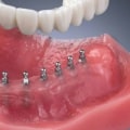 The Pros and Cons of Mini Dental Implants: A Comprehensive Look