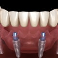 The Complete Guide to All-on-4 Implants: Everything You Need to Know