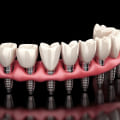 Benefits and Limitations of Alternatives to Traditional Dental Implants