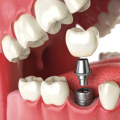 Placing the Permanent Crown on the Implant: Everything You Need to Know