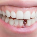 All You Need to Know About Additional Procedures and Treatments for Tooth Implants