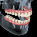 Recovery and Maintenance After Dental Implant Surgery: What You Need to Know