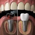 The Impact of Smoking on Dental Implants: What You Need to Know