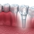 The Process of Osseointegration: A Comprehensive Guide to Dental Implants