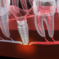 Understanding Nerve Damage During Dental Implant Surgery