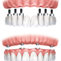 Other Options for Full-Arch Restoration: Exploring Alternatives to Traditional Dental Implants