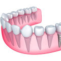 All You Need to Know About Dental Implants