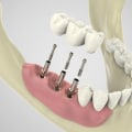 Preparing Your Jawbone for Dental Implant Placement: What You Need to Know