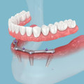 All-on-4 Implants: The Solution for Missing Teeth