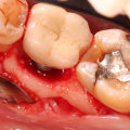 Understanding Infection at the Implant Site