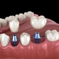 Different Types of Abutments Used for Dental Implants: A Comprehensive Guide