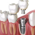 Cleaning and Caring for Dental Implants: A Complete Guide