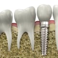 Dietary Changes for Maintaining Healthy Implants: Tips and Tricks to Keep Your Tooth Implants Strong and Functional