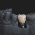 Types of Insurance for Dental Implants