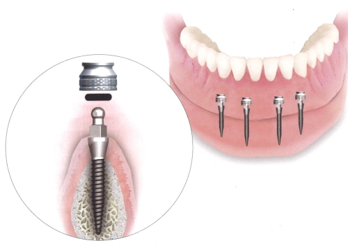 Understanding Mini Dental Implants