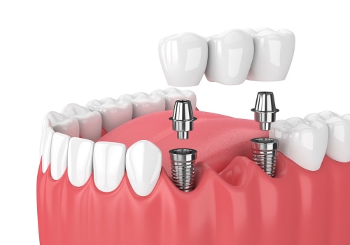 Financing Options for Those Without Insurance: Covering the Cost of Dental Implants