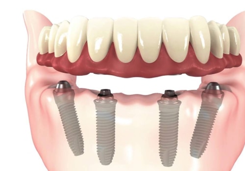 The Benefits of All-on-4 Implants