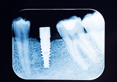 All You Need to Know About X-Rays and Imaging for Dental Implants