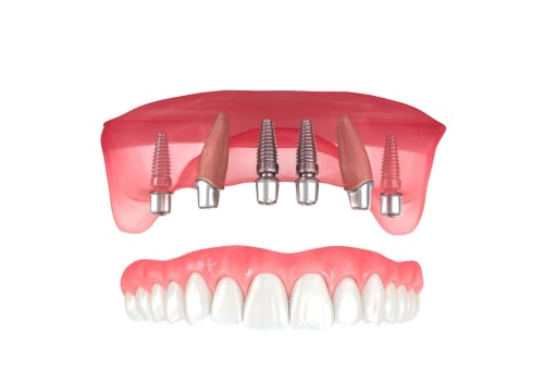 Instructions Before Surgery for Dental Implants