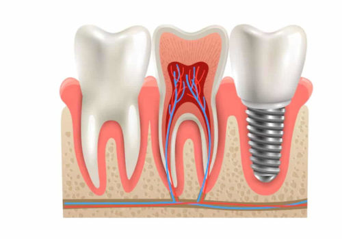 Understanding Endosteal Implants: A Complete Guide