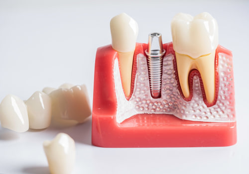 Determining Eligibility for Dental Implants: A Comprehensive Guide