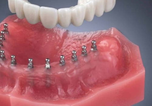 The Pros and Cons of Mini Dental Implants: A Comprehensive Look