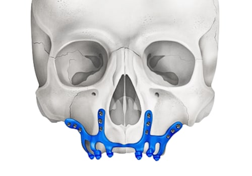 The Benefits of Subperiosteal Implants: Improving Your Oral Health and Appearance