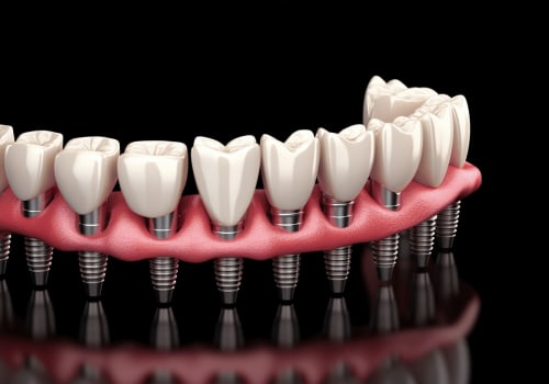 Benefits and Limitations of Alternatives to Traditional Dental Implants