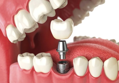 Placing the Permanent Crown on the Implant: Everything You Need to Know