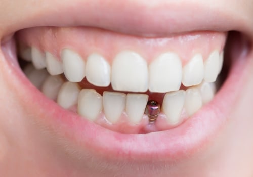 All You Need to Know About Additional Procedures and Treatments for Tooth Implants