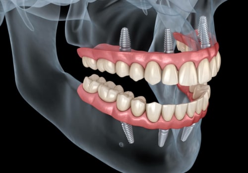 Recovery and Maintenance After Dental Implant Surgery: What You Need to Know