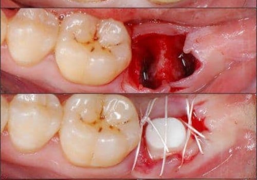 Pain Management After Dental Implant Surgery: What You Need to Know