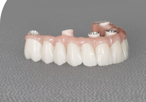 Understanding Implant Failure and Rejection: What You Need to Know