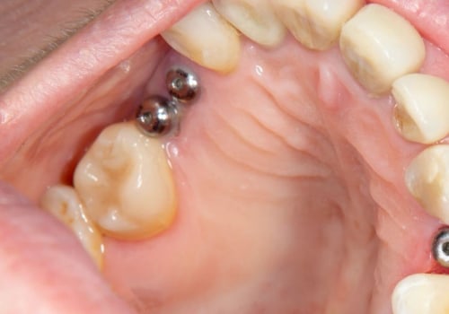 Exploring the Different Types of Anesthesia Used During Dental Implant Placement