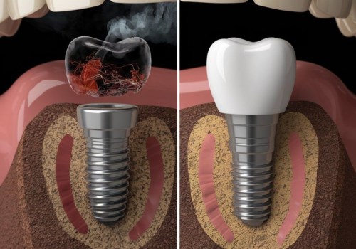 The Impact of Smoking on Dental Implants: What You Need to Know