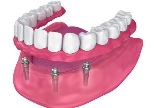 All You Need to Know About the Number of Implants Needed for Dental Health