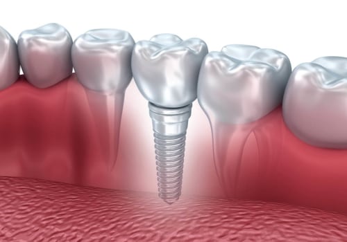 The Process of Osseointegration: A Comprehensive Guide to Dental Implants