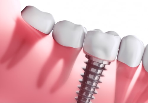 All About Dental Implants: Types, Costs, and Alternatives