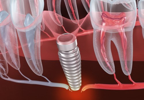 Understanding Nerve Damage During Dental Implant Surgery