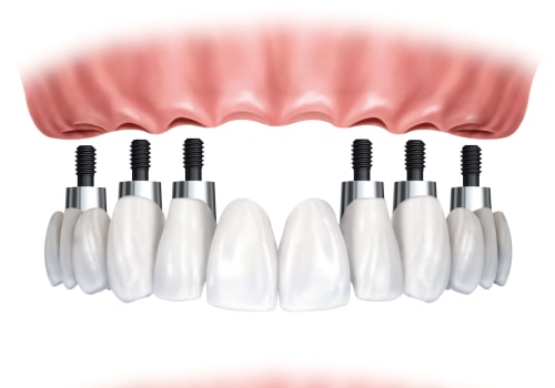 Other Options for Full-Arch Restoration: Exploring Alternatives to Traditional Dental Implants