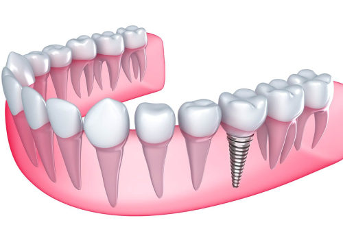 All You Need to Know About Dental Implants