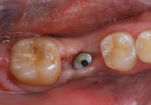 Understanding the Recovery Timeline After Dental Implant Placement